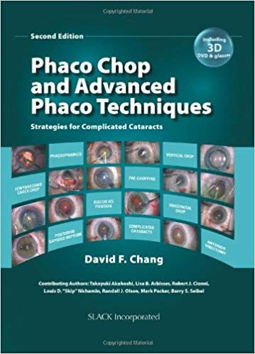 Phaco Chop and Advanced Phaco Techniques Strategies for Complicated Cataracts 2nd